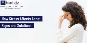‘How Stress Affects Acne: Signs and Solutions’